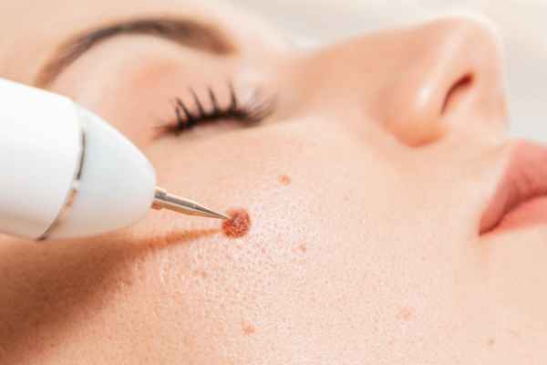 CryoPen: 5 Skin Concerns It May Be Used to Treat 3 What actually happens during a CryoPen treatment Garswood?
