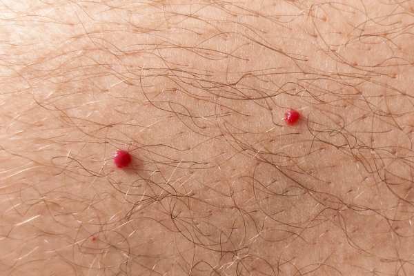 CryoPen: 5 Skin Concerns It May Be Used to Treat 2 cherry angioma removal Garswood