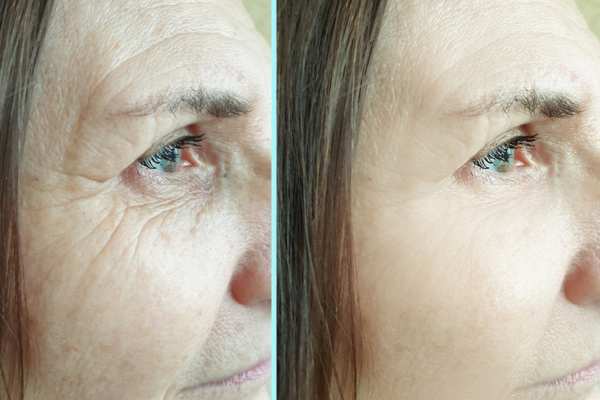Why Do People Choose HIFU for a Non-Surgical Facelift? 4 How long can HIFU results last Garswood?