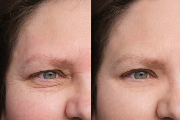 HIFU vs Botulinum Toxin: Understanding the Differences 4 How long do HIFU results last Garswood?