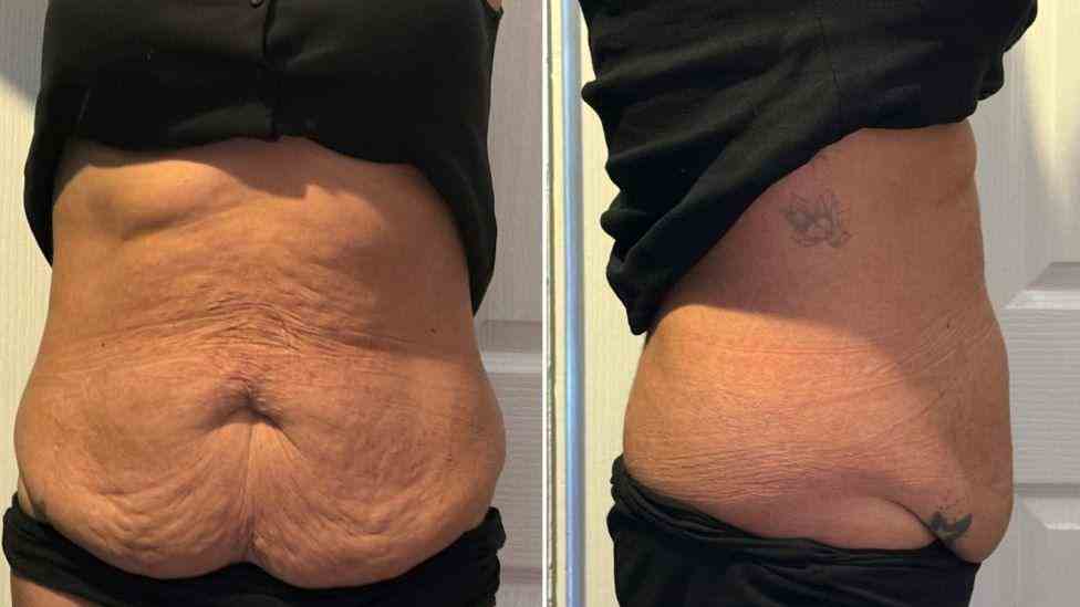 Lost the Weight but Not the Loose Skin? What You Should Know 1 Is It Definitely Loose Skin Garswood?